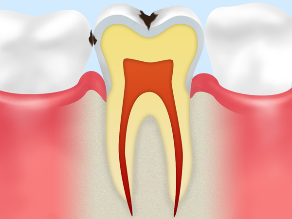 C1　歯の表面の虫歯