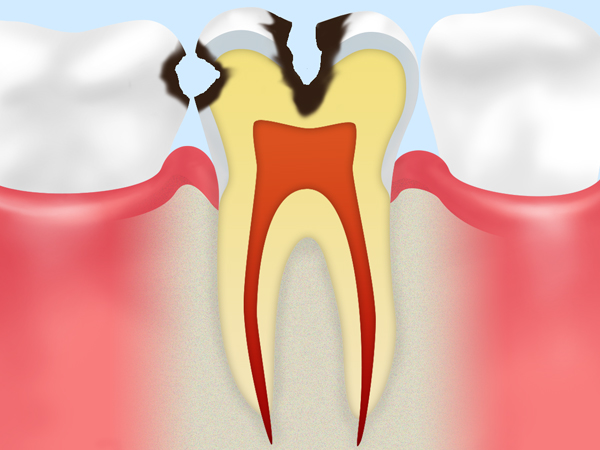 C2　神経に近い虫歯
